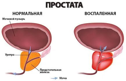 Prostatita ce este, ceea ce este periculos, simptomele și tratamentul prostatitei