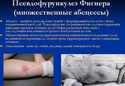 Psevdofurunkulez пръсти симптоми и лечение при бебета и деца