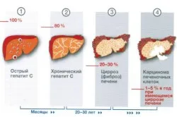 Reaktív hepatitis gyermekeknél tünetek, okok, kezelés