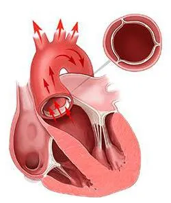 Heart подмяна и експлоатация на възможните болести клапан