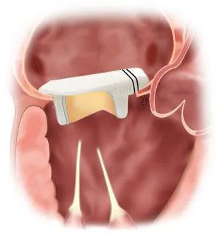 înlocuirea valvei cardiace și operarea posibile boli