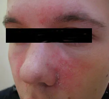 Seborrhoeás dermatitis, tünetei és okai, kezelési módszerek, fotók és vélemények