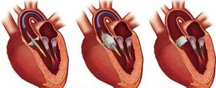 Heart подмяна и експлоатация на възможните болести клапан