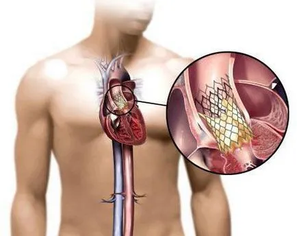 Heart подмяна и експлоатация на възможните болести клапан