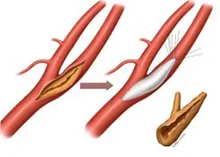ateroscleroza constrictiv tratamentului arterei brachiocefalic, ocluzia arterelor carotide și vertebrale