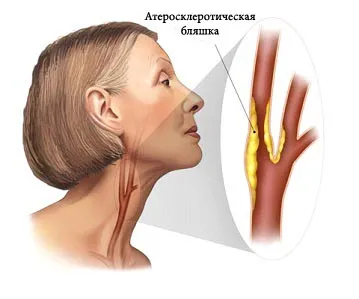 Összeszorítással atherosclerosis brachiocephalica kezelésére, elzáródása a nyaki és csigolya-artériákat