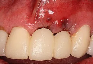 Az implantátumok veszélyesek fogak - ellenjavallatok és kockázatok