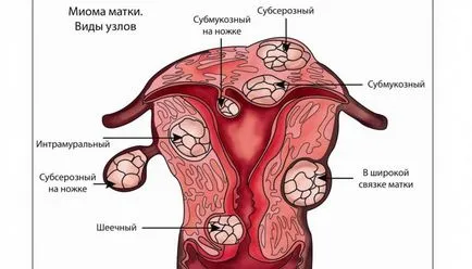 Nyálkahártya alatti myoma méhet kezelés hagyományos módszerekkel, a tabletták és a működés