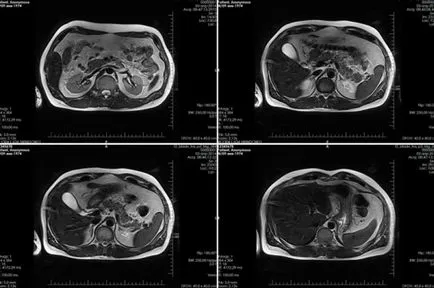 Tomografia a abdomenului arată că