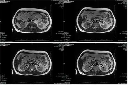 Tomografia a abdomenului arată că