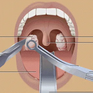 Îndepărtarea amigdalelor de tipuri de laser, argumente pro și contra de chirurgie, consecințele, secretwoman