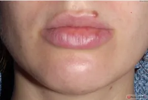 Mărirea buzelor cu efecte de acid hialuronic și contraindicații