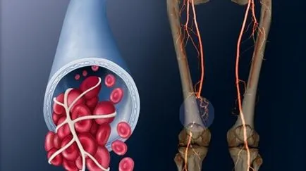 Ultrahang és Doppler ultrahang az alsó végtagok (lábak)