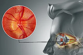 Maxillaris vagy arcüreg melléküregek - melyek és miért van szükség