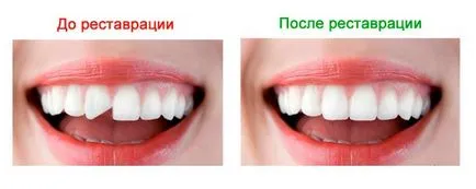 Фасетите са плюсовете и минусите на инсталирането им за вашата усмивка