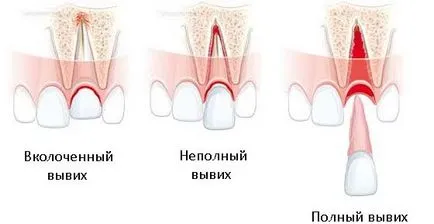 Разместване на зъб пълен и непълен