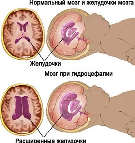 hipertensiune intracraniană - simptome, cauze, tratament și diagnostic