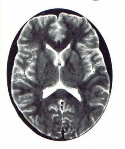 hipertensiune intracraniană - simptome, cauze, tratament și diagnostic