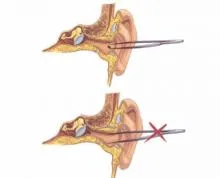 Ce se întâmplă dacă ceva luat în clinica ureche ureche, nas și gât