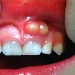 Vindecarea gingiilor dupa caracteristicilor procesului de implantare și durata