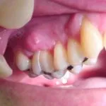 Vindecarea gingiilor dupa caracteristicilor procesului de implantare și durata