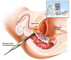 Зареждане на простатата за лечение и профилактика