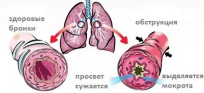 Посочени в гърдите кашлица суха