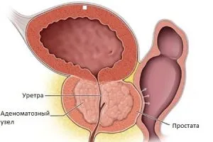 Prostatică etapă nod adenomatoasă de dezvoltare