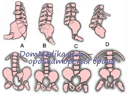 Agenezie de sacrum cauze, clasificare, diagnostic