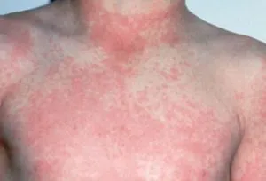 Allergiás bőrkiütés gyermekeknél