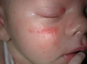 Allergiás bőrkiütés gyermekeknél