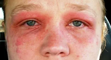Alergia la vodcă și cauzele simptomelor alergice