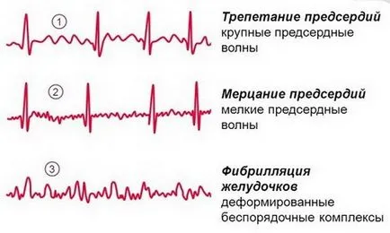 Сърдечна аритмия - какво е това и как да се лекува симптомите