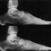 Osteoartrita talo navicular articulare 1 si 2 grade, tratament, dureri articulare