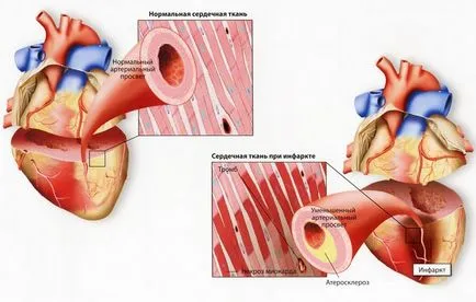 Ateroscleroza de aorta a inimii - ceea ce este, simptomele și tratamentul de etanșare pereții aortei și pliante