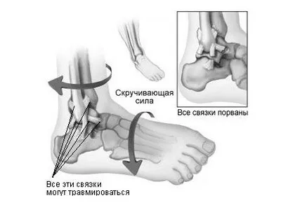 dureri de gleznă la mersul pe jos - glezne dureri de artrita sau artrita, mizerie și mizerie