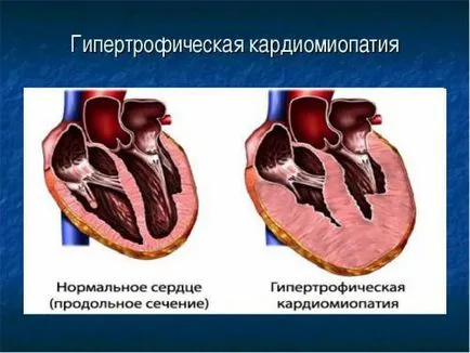 Болката в сърцето на симптомите и признаците на сърцето болка