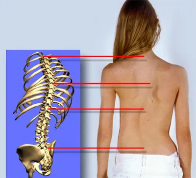 Какво заплашва лекарите кривина позата открити признаци на болестта на задната