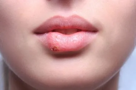 După câte zile trec herpes labial