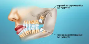 Какво е задържането на зъби