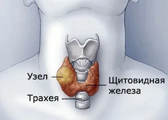 Какво прави ЯМР и КТ на щитовидната жлеза