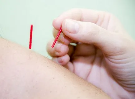 Ce este acupunctura la fel de des efectua procedura în cazul în care există contraindicații cu acupunctura