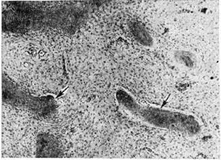 osteodysplasia fibroasă 2