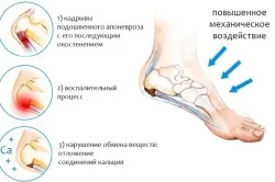 Fizioterapie la pintenul călcâi