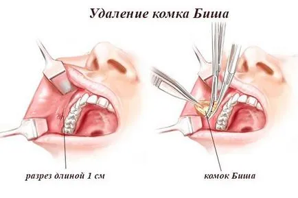 Френските бузите (метод на автора) в Москва