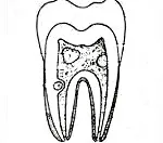 Dentikli - cauze, simptome, diagnostic și tratament