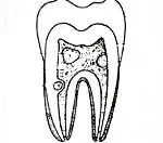 Dentikli - причини, симптоми, диагностика и лечение