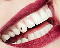 Декоративни стоматология, Skys, shikerdent - Елегантен стоматология