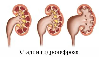 Hydronephrosis okok, tünetek, kezelés