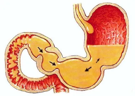 Gastroduodenitis, duodeno-gyomorrefluxot (DGR), krónikus, felületes, GERD - tünetek és